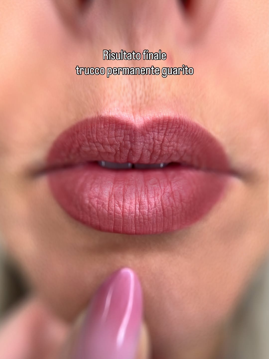 Risultato guarito del trattamento BOOP Lips
