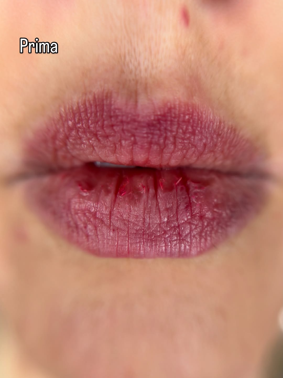 Labbra prima del trattamento BOOP Lips